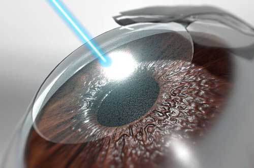Close-up image of LASIK eye surgery in progress at Kenia Eye Hospital