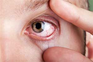 Illustration depicting symptoms and causes of dry eye syndrome