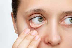 Visual showing treatments and relief options for dry eye condition