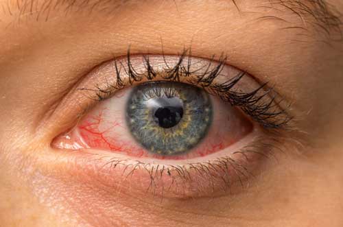 Informative image about dry eye syndrome causes and management tips