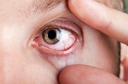 Image explaining symptoms and care strategies for dry eye syndrome