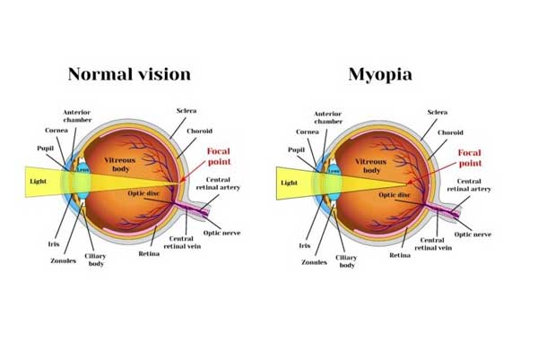 myopia img