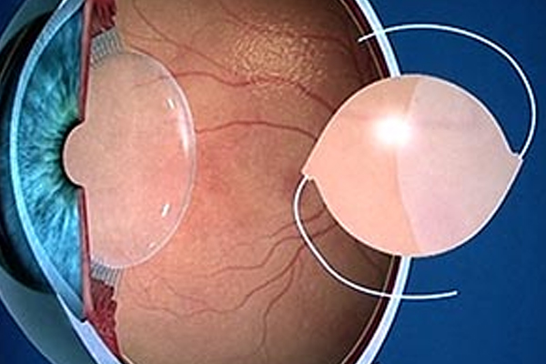 prelex eye surgery
