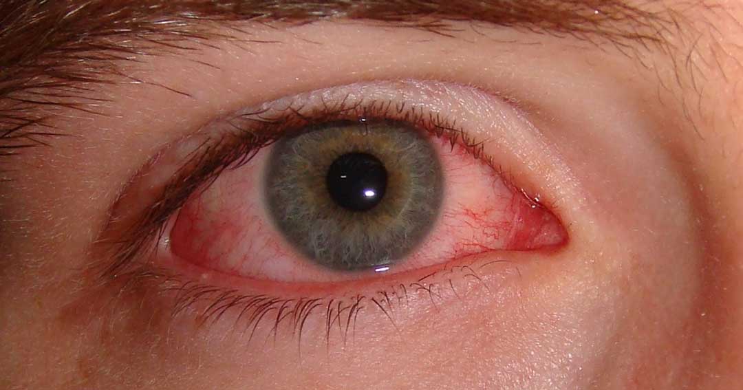 Image illustrating common eye allergies and symptoms managed at Kenia Eye Hospital