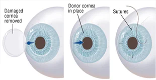 Kenia Eye Hospital