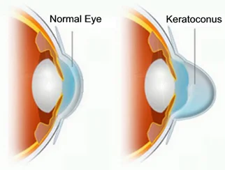 Kenia Eye Hospital