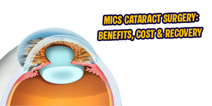 MICS Cataract Surgery