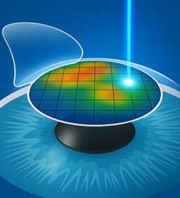 Custom LASIK