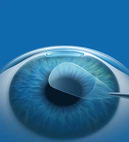 Flapless LASIK CLEAR
