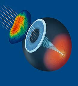 Wavefront Guided LASIK
